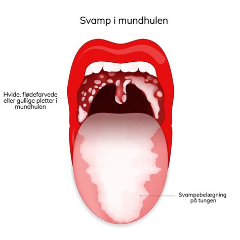Infeksjon i munnen symptomer